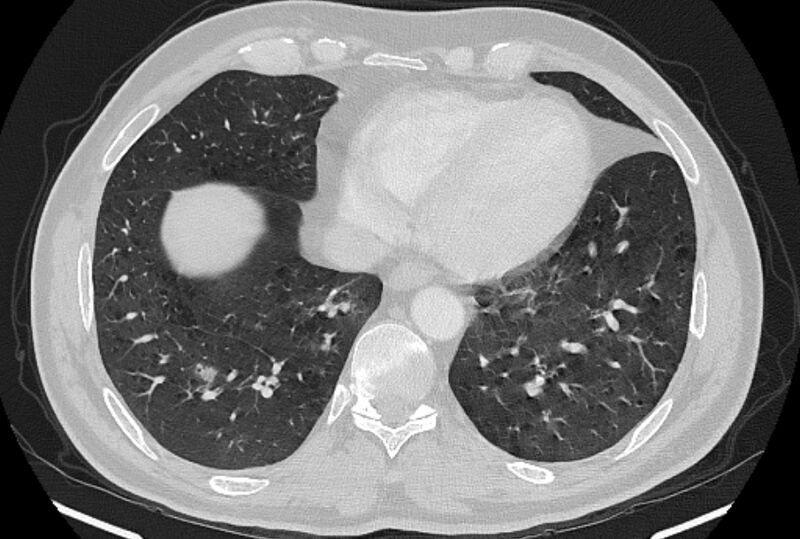 File:Brain metastases - lung cancer primary (Radiopaedia 75060-86116 Axial lung window 45).jpg