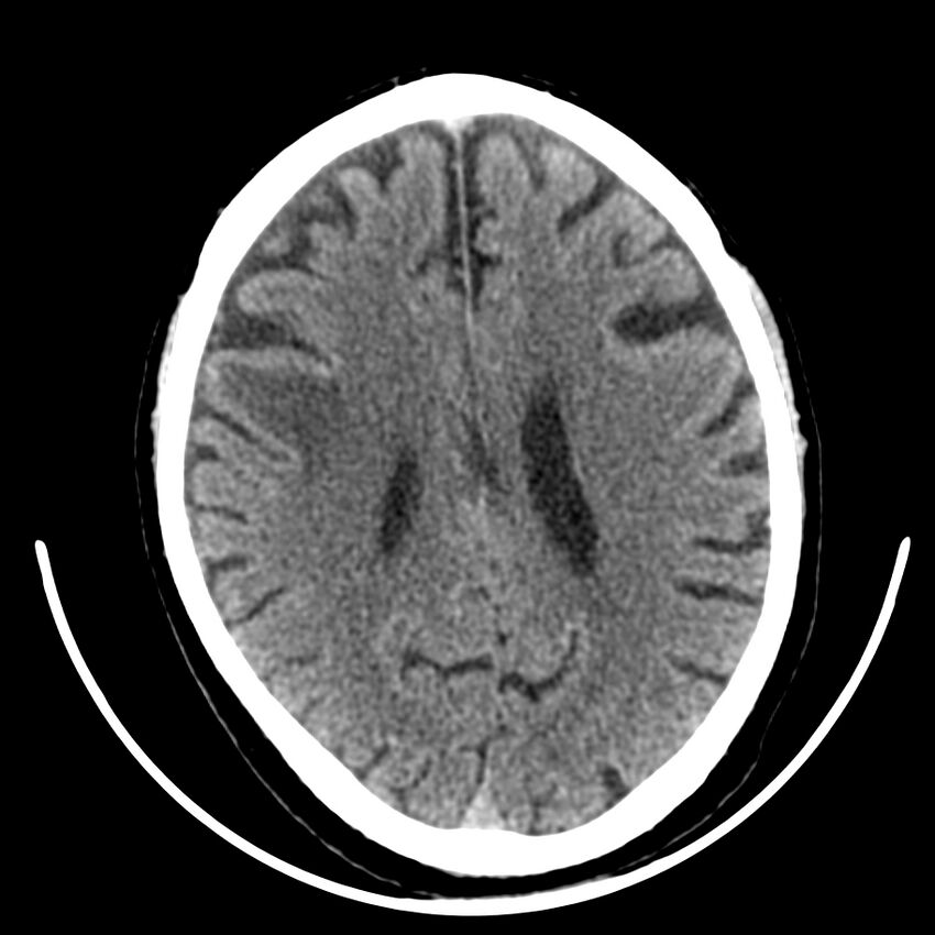 Brain metastasis (Radiopaedia 42617-45760 Axial non-contrast 31).jpg