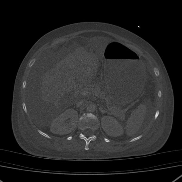 File:Breast cancer metastases - hepatic and skeletal (Radiopaedia 34201-35461 Axial bone window 46).jpg
