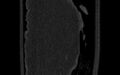 Breast carcinoma with pathological hip fracture (Radiopaedia 60314-67993 Coronal bone window 105).jpg