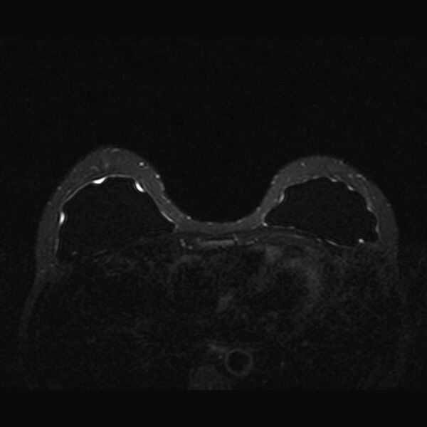 File:Breast implants - MRI (Radiopaedia 26864-27035 T2 SPAIR 20).jpg