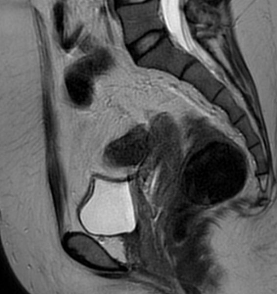 File:Broad ligament leiomyoma (Radiopaedia 81634-95516 Sagittal T2 16).jpg