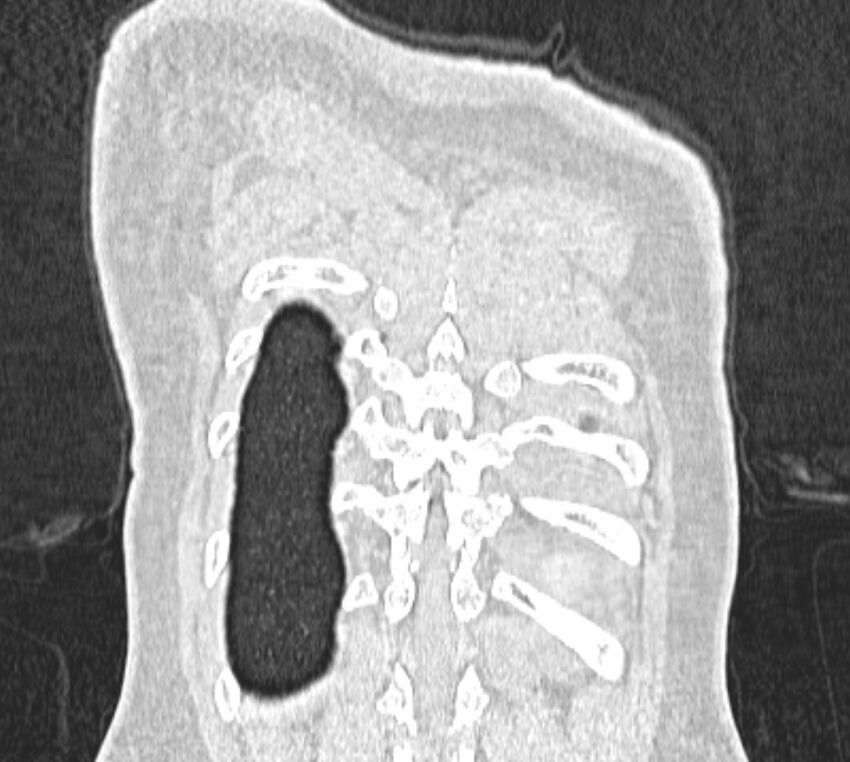 Bronchial atresia (Radiopaedia 50007-55297 Coronal lung window 112).jpg