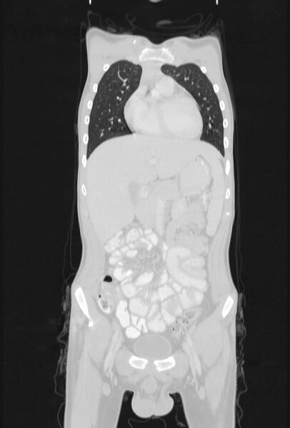 File:Bronchial carcinoid tumor (Radiopaedia 57187-64090 Coronal lung window 25).jpg