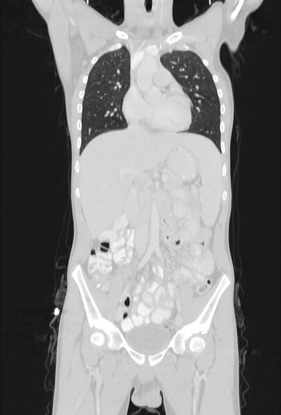 File:Bronchial carcinoid tumor (Radiopaedia 57187-64090 Coronal lung window 36).jpg