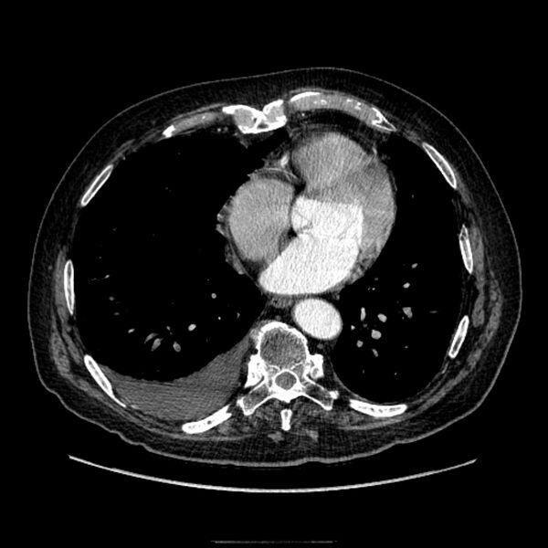 File:Bronchogenic adenocarcinoma and pulmonary embolism (Radiopaedia 9097-9806 D 41).jpg