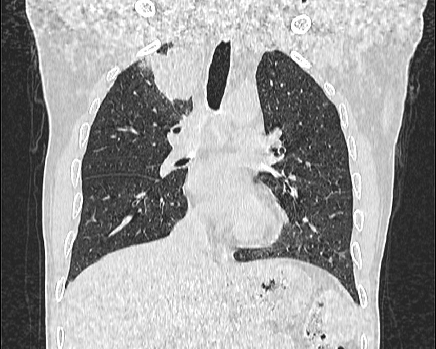 Bronchogenic carcinoma with superior vena cava syndrome (Radiopaedia 36497-38054 Coronal lung window 35).jpg