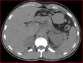 Burned-out testicular choriocarcinoma (Radiopaedia 32822-34040 Axial non-contrast 2).jpg