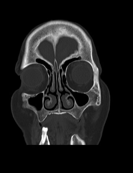 File:Burnt-out meningioma (Radiopaedia 51557-57337 Coronal bone window 6).jpg
