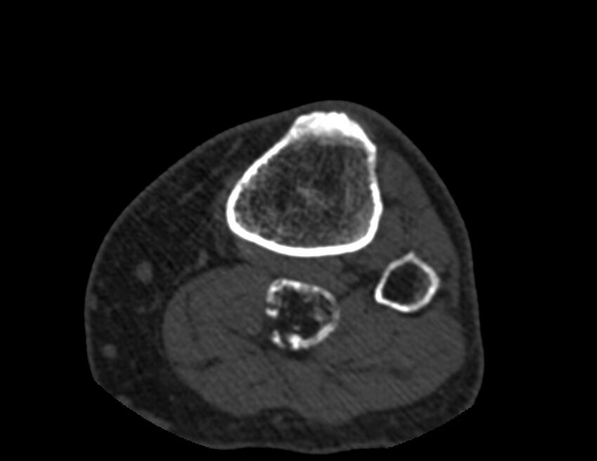 Calcified hematoma - popliteal fossa (Radiopaedia 63938-72763 Axial bone window 87).jpg