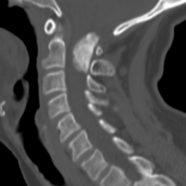File:Calcified meningioma - cervical canal (Radiopaedia 70136-80171 Sagittal bone window 20).jpg