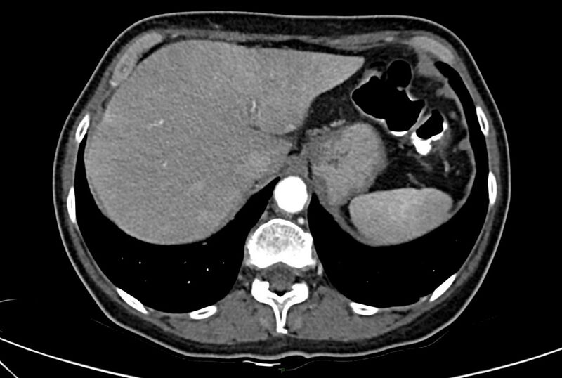 File:Carcinoid mesenteric tumor complicated by chylous ascites (Radiopaedia 76312-88926 A 12).jpg