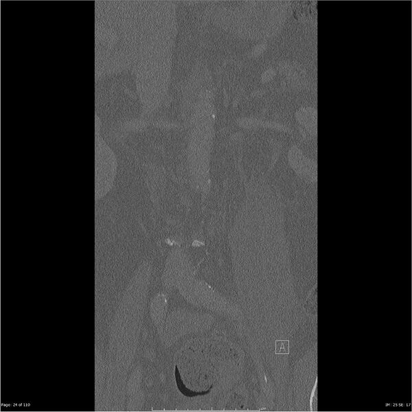 File:Cardiac trauma (Radiopaedia 32874-33858 Coronal bone window 24).jpg