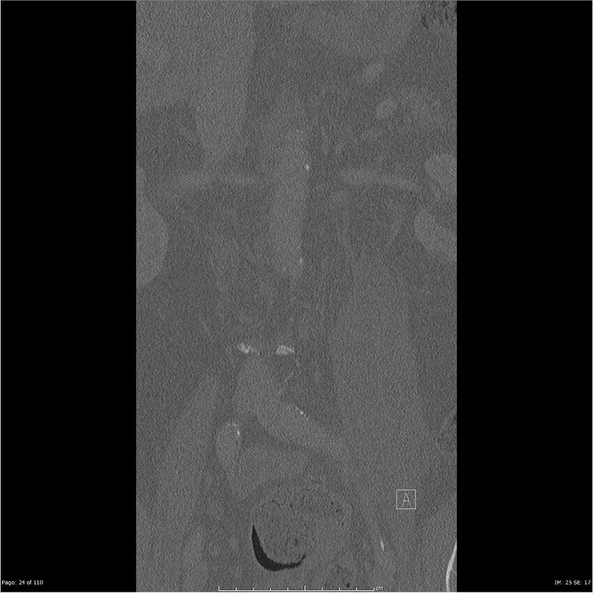 Cardiac trauma (Radiopaedia 32874-33858 Coronal bone window 24).jpg