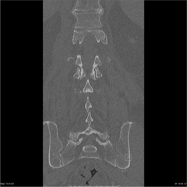 File:Cardiac trauma (Radiopaedia 32874-33858 Coronal bone window 75).jpg