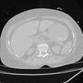 Cardiogenic pulmonary edema (Radiopaedia 29213-29609 Axial lung window 116).jpg