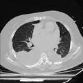 Cardiogenic pulmonary edema (Radiopaedia 29213-29609 Axial lung window 51).jpg