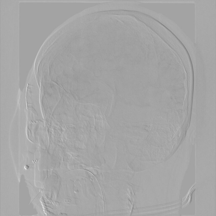 Caroticocavernous fistula - direct (Radiopaedia 61660-69666 Oblique Left ICA 38).jpg