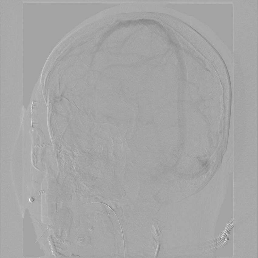 Caroticocavernous fistula - direct (Radiopaedia 61660-69666 Oblique Left ICA 60).jpg