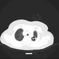 Carotid body tumor (Radiopaedia 21021-20948 Axial lung window 4).jpg