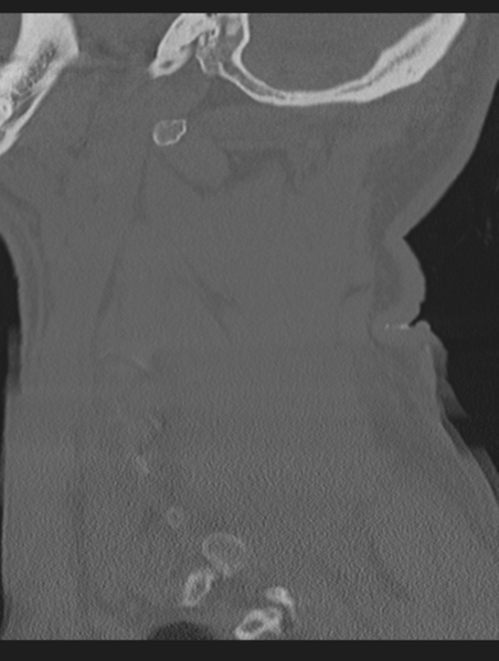 File:Cavernoma of cervical cord (Radiopaedia 50838-56346 Sagittal bone window 66).png