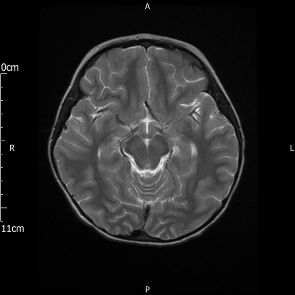 File:Cavernous sinus thrombosis (Radiopaedia 79414-92512 Axial T2 13).jpg