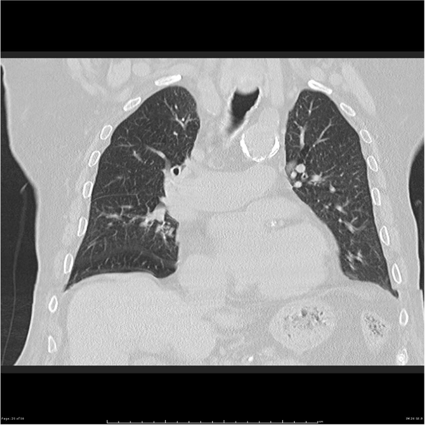Cavitating left lower lobe lesion - squamous cell lung cancer (Radiopaedia 27749-28176 Coronal lung window 25).jpg