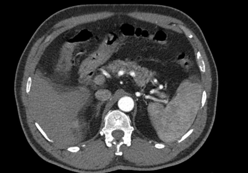 File:Celiac artery dissection (Radiopaedia 52194-58080 A 25).jpg
