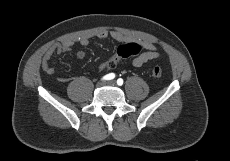 File:Celiac artery dissection (Radiopaedia 52194-58080 A 78).jpg