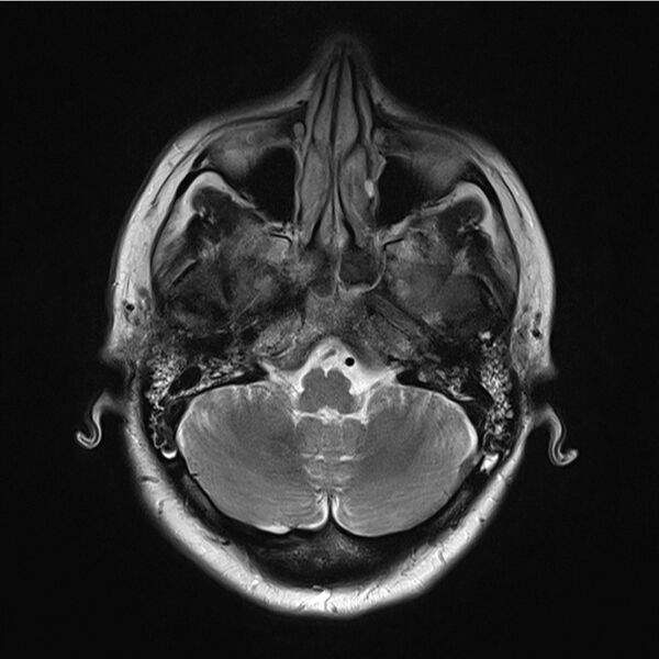 File:Central base of skull meningioma (Radiopaedia 53531-59549 Axial T2 5).jpg
