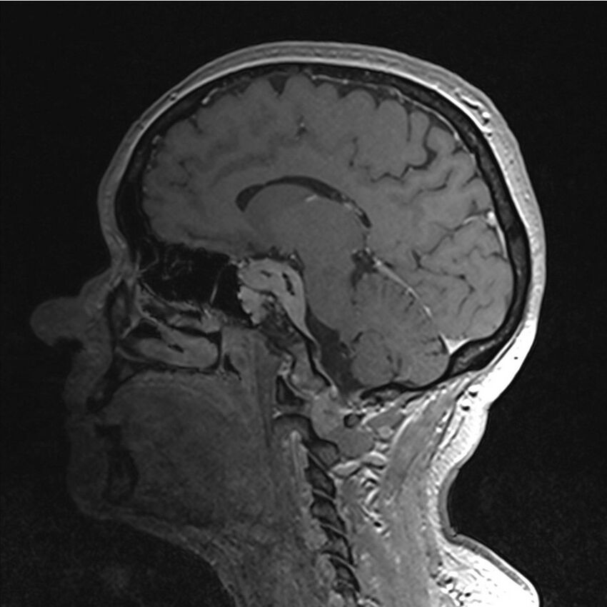 Central base of skull meningioma (Radiopaedia 53531-59549 Sagittal T1 C+ 36).jpg