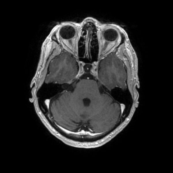 File:Central neurocytoma (Radiopaedia 67618-77021 Axial T1 C+ 8).jpg