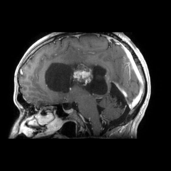 File:Central neurocytoma (Radiopaedia 67618-77021 Sagittal T1 C+ 14).jpg