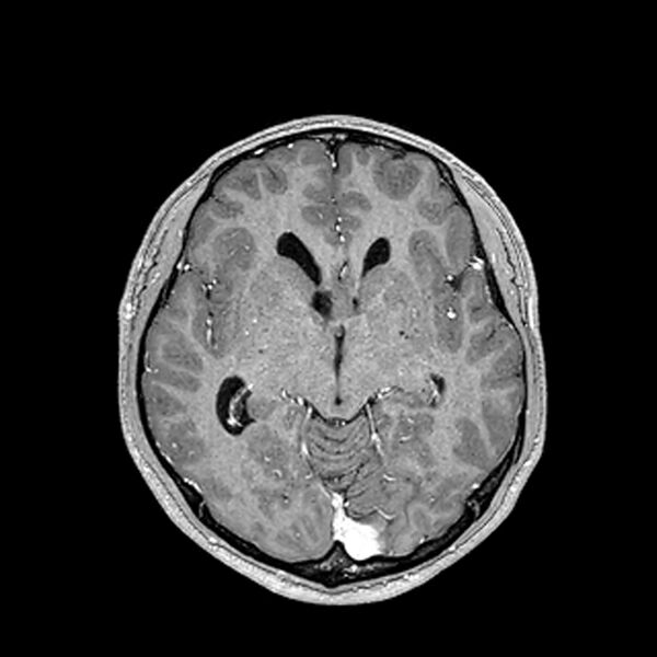 File:Central neurocytoma (Radiopaedia 79320-92380 Axial T1 C+ 114).jpg