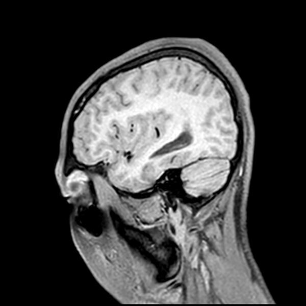File:Central neurocytoma (Radiopaedia 79320-92380 Sagittal T1 199).jpg