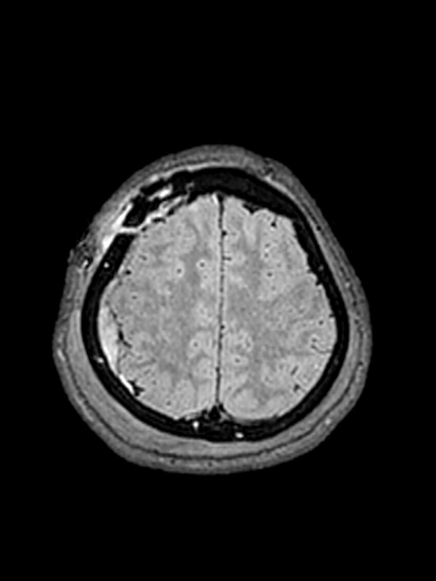 Central neurocytoma (Radiopaedia 79320-92381 Axial FLAIR 43).jpg