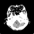 Cerebellar abscess secondary to mastoiditis (Radiopaedia 26284-26412 Axial non-contrast 23).jpg