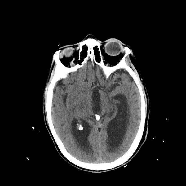 File:Cerebellar metastasis - lung tumor (Radiopaedia 69317-79145 Axial non-contrast 16).jpg