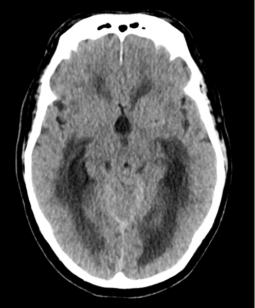 File:Cerebellar metastasis from lung adenocarcinoma (Radiopaedia 86690-102828 Axial non-contrast 13).png