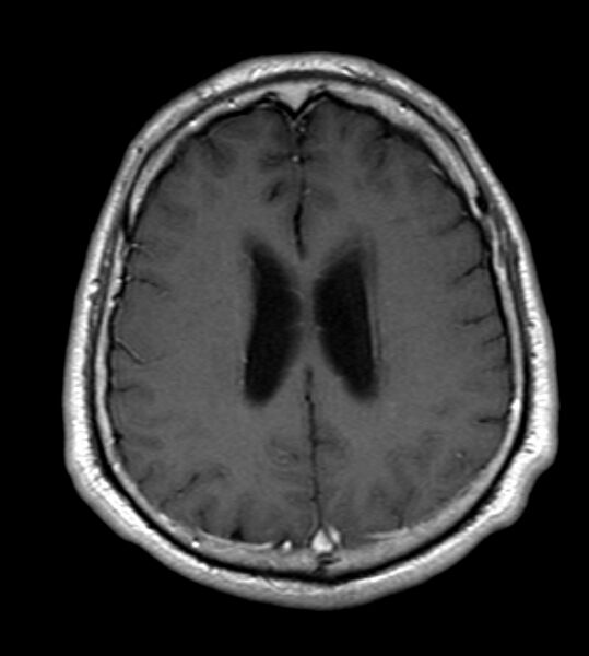 File:Cerebellopontine angle meningioma (Radiopaedia 24459-24764 Axial T1 C+ 17).jpg