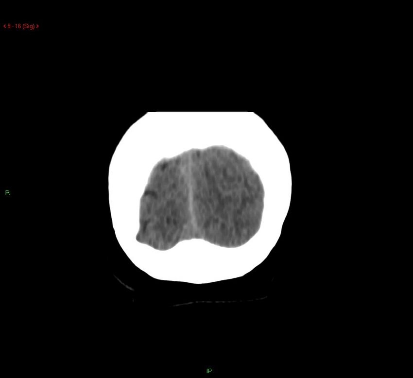 Cerebral amyloid angiopathy-associated lobar intracerebral hemorrhage (Radiopaedia 58378-65518 Coronal non-contrast 16).jpg