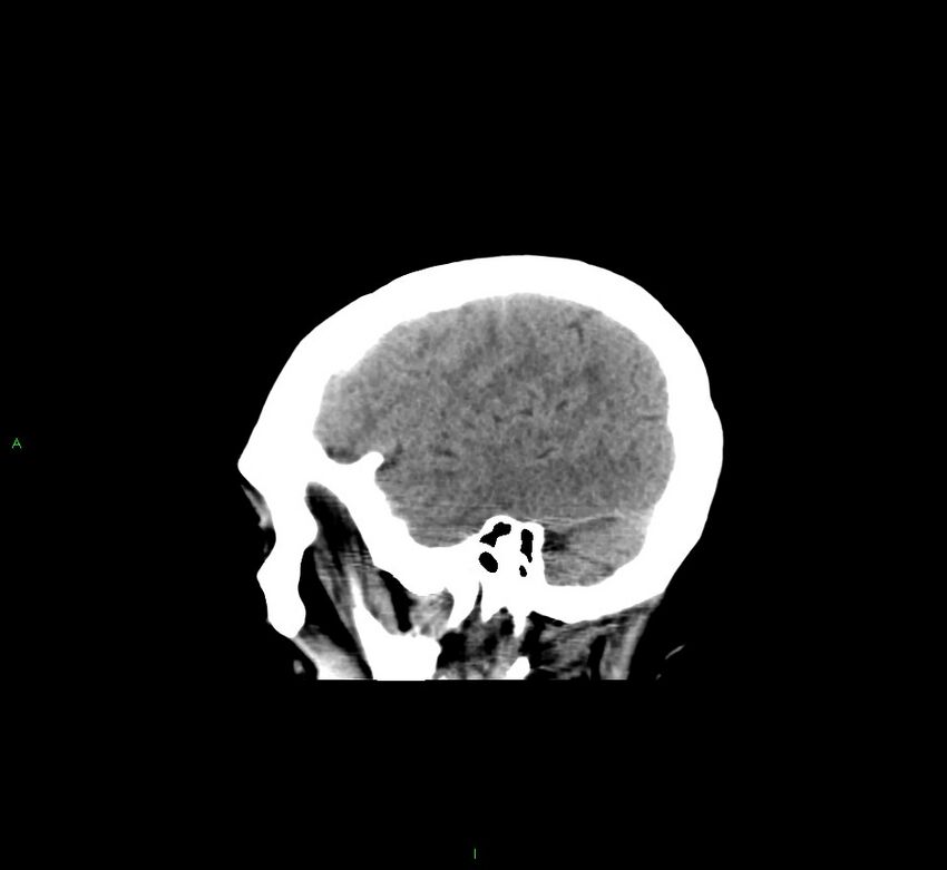 Cerebral amyloid angiopathy-associated lobar intracerebral hemorrhage (Radiopaedia 58529-65681 B 40).jpg