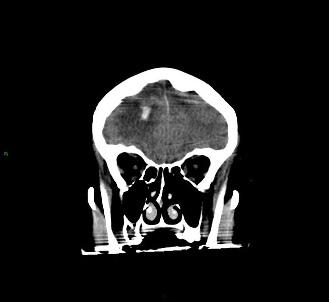 File:Cerebral amyloid angiopathy-associated lobar intracerebral hemorrhage (Radiopaedia 58560-65723 Coronal non-contrast 54).jpg