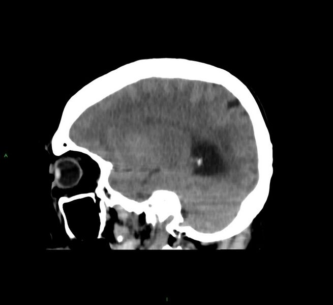 File:Cerebral amyloid angiopathy-associated lobar intracerebral hemorrhage (Radiopaedia 58751-65972 C 38).jpg