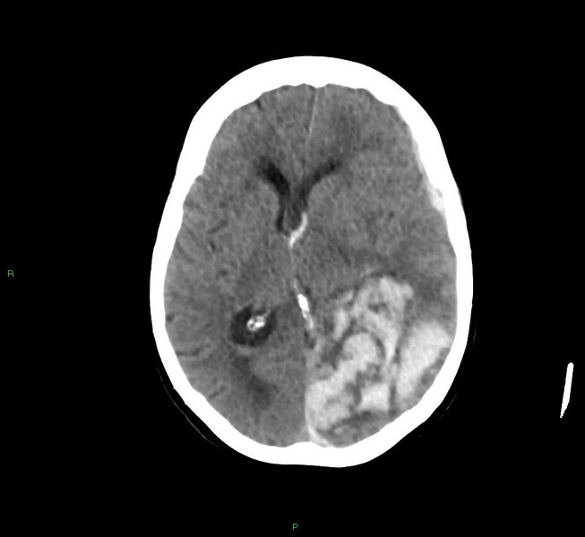 File:Cerebral amyloid angiopathy-associated lobar intracerebral hemorrhage (Radiopaedia 58754-65975 Axial non-contrast 33).jpg