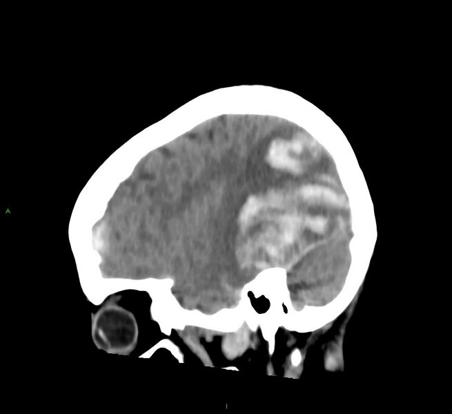 File:Cerebral amyloid angiopathy-associated lobar intracerebral hemorrhage (Radiopaedia 58754-65975 C 37).jpg