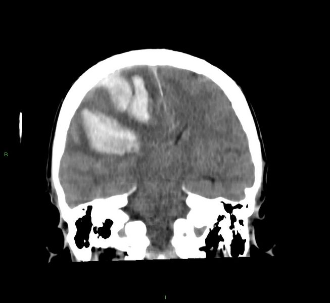 File:Cerebral amyloid angiopathy-associated lobar intracerebral hemorrhage (Radiopaedia 58756-65977 Coronal non-contrast 33).jpg