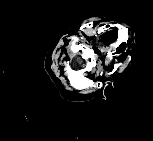 File:Cerebral amyloid angiopathy-associated lobar intracerebral hemorrhage (Radiopaedia 58757-65979 Axial non-contrast 11).jpg