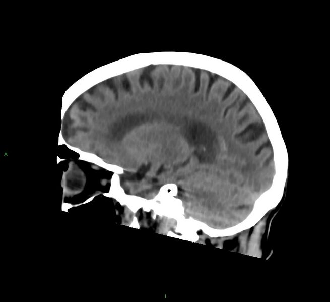 File:Cerebral amyloid angiopathy-associated lobar intracerebral hemorrhage (Radiopaedia 58758-65980 C 36).jpg
