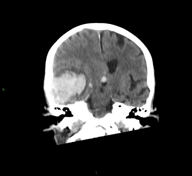 File:Cerebral amyloid angiopathy-associated lobar intracerebral hemorrhage (Radiopaedia 58758-65980 Coronal non-contrast 33).jpg